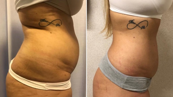 criofrequencia quality life barra antes e depois