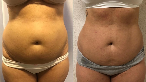 criofrequencia quality life barra antes e depois